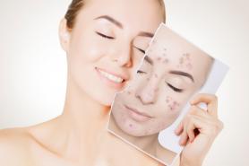 Tratamento de acne